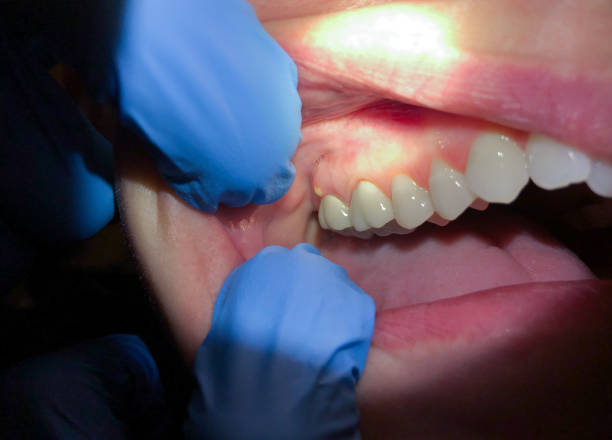 Best Root Canal Emergency Dentist  in Camp Hill, AL